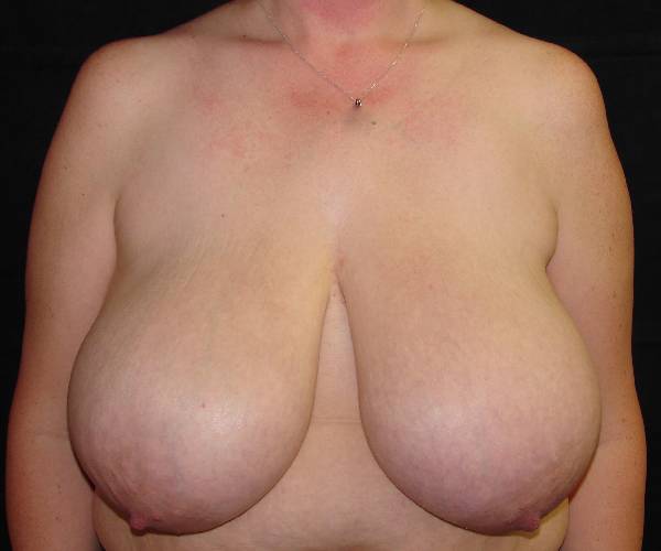 before breast reduction front view female patient case 3982