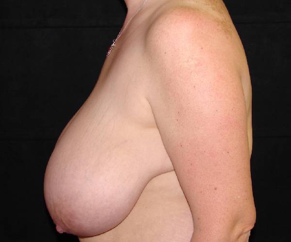 before breast reduction left view female patient case 3982