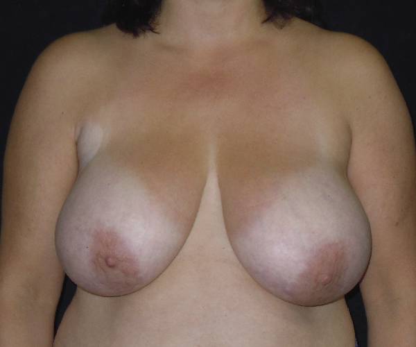 before breast reduction front view female patient case 4001