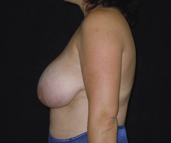 before breast reduction left view female patient case 4001
