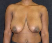 before breast reduction front view female patient case 4006