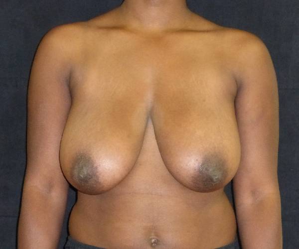 before breast reduction front view female patient case 4006