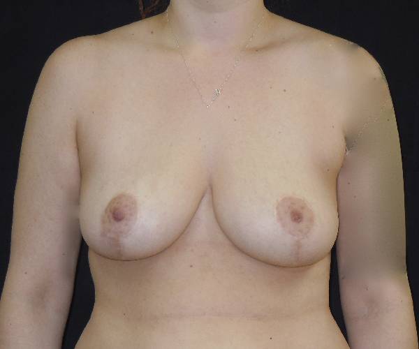 after breast reduction front view female patient case 4016