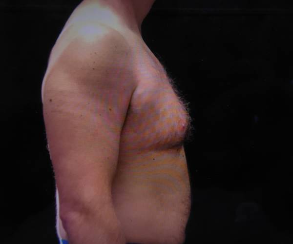before Gynecomastia side view case 3475