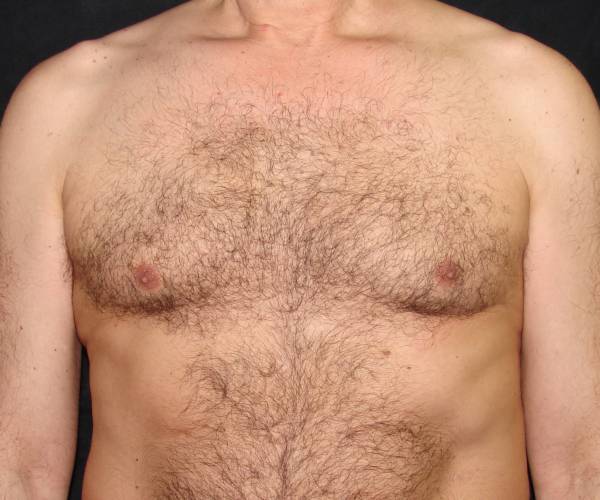 before Gynecomastia front view case 3485