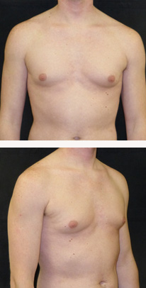 before Gynecomastia case 3551 front and angle view