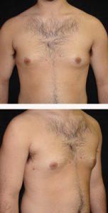 after Gynecomastia case 3557 front and angle view