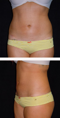 after liposuction female patient front & side view case 3334