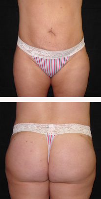 after liposuction female patient front view case 3349