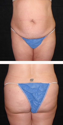 before liposuction female patient front view case 3349