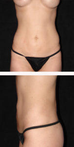 after liposuction front and side view female patient case 5