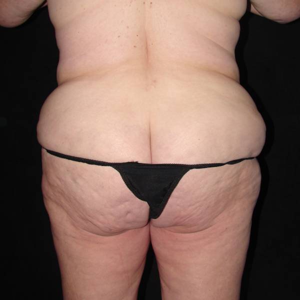 before body lift back view female patient case 4279