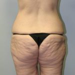 before body lift back view female patient case 4284