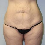 before body lift front view female patient case 4284