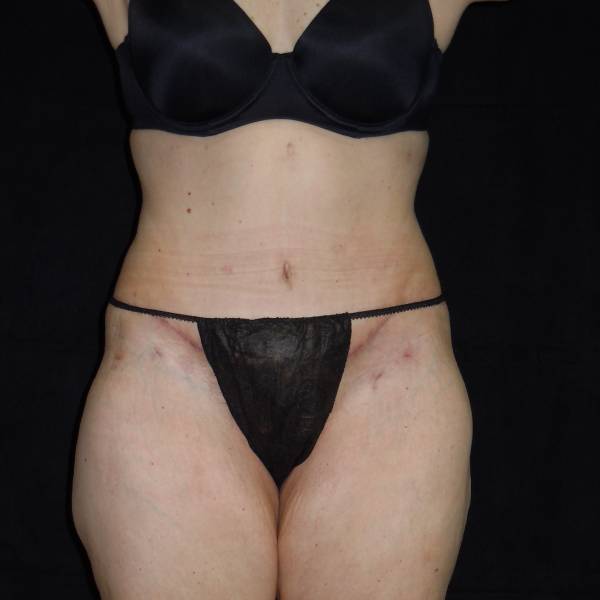 after body lift front view female patient case 4308