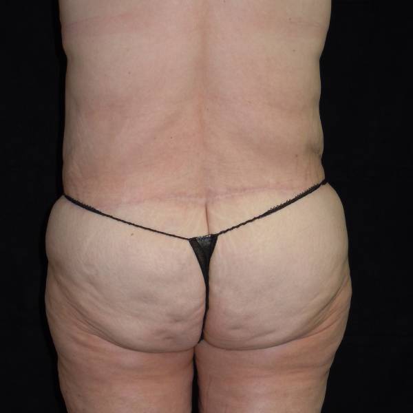 after body lift back view female patient case 4314