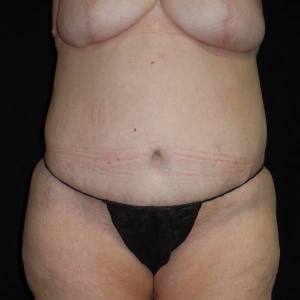 after body lift front view female patient case 4314