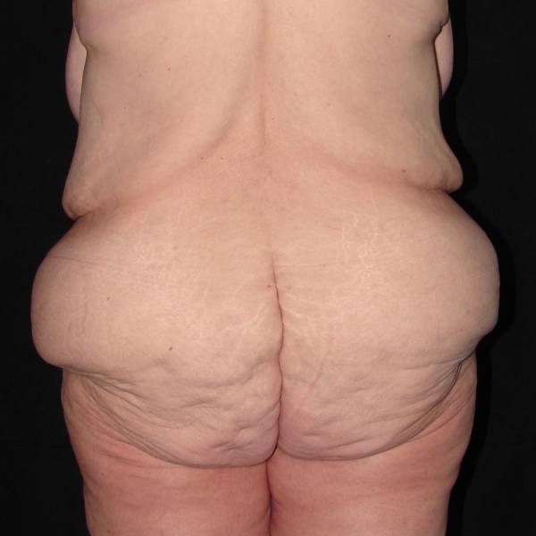 before body lift back view female patient case 4314