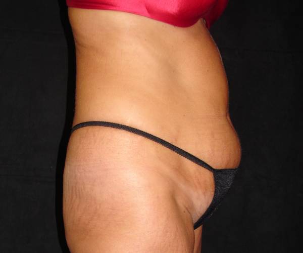 before tummy tuck right side view female patient case 4339